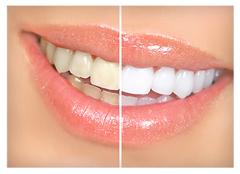 Teeth Whitening