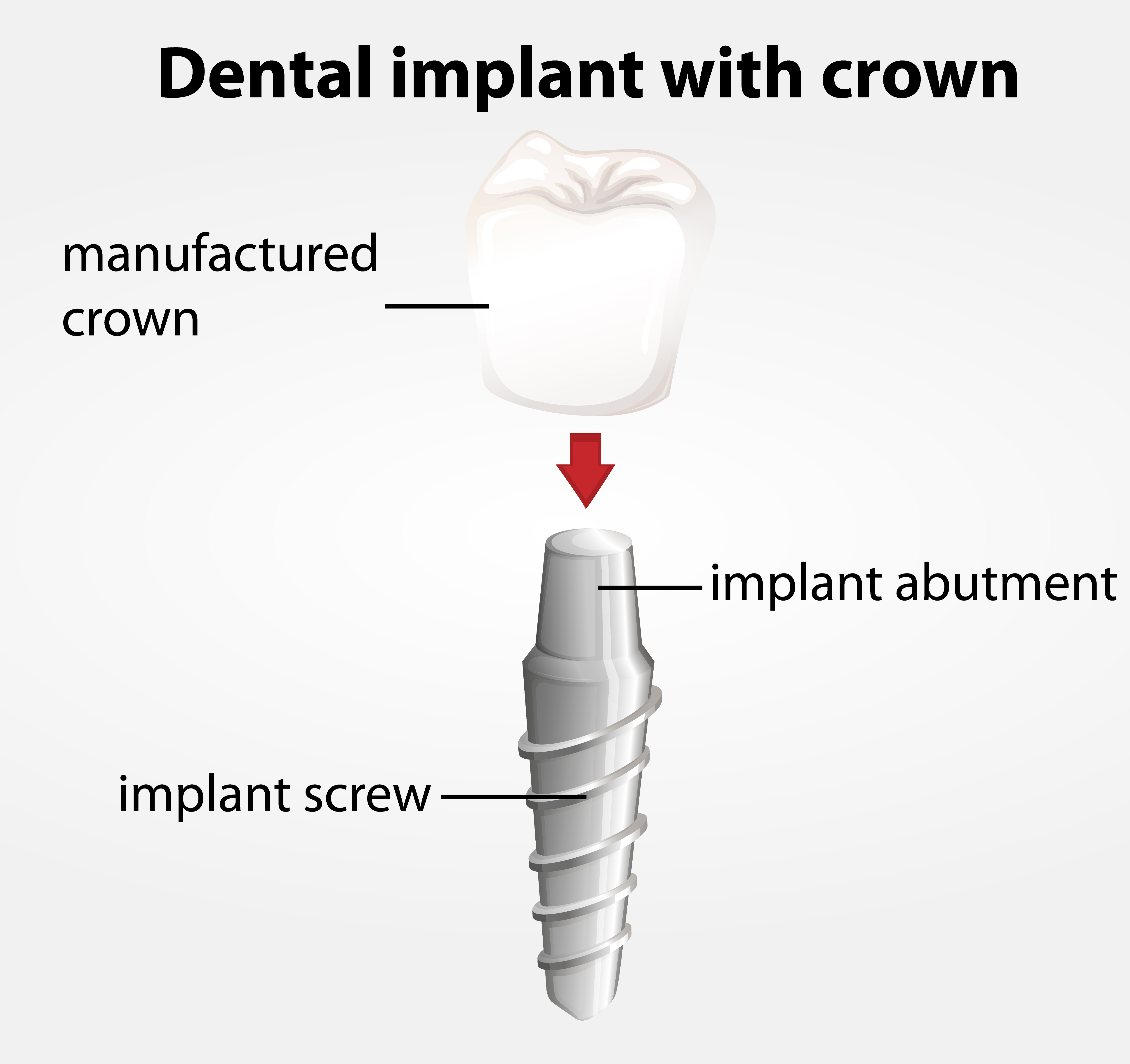 Restorative Implants