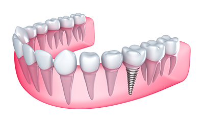 Single Tooth Implants