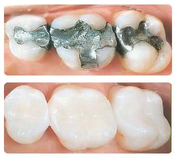 Tooth Colored Fillings