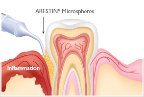 Gum Disease Treatment